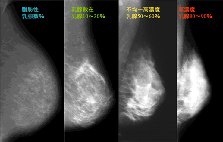 breast_cancer_3.jpg