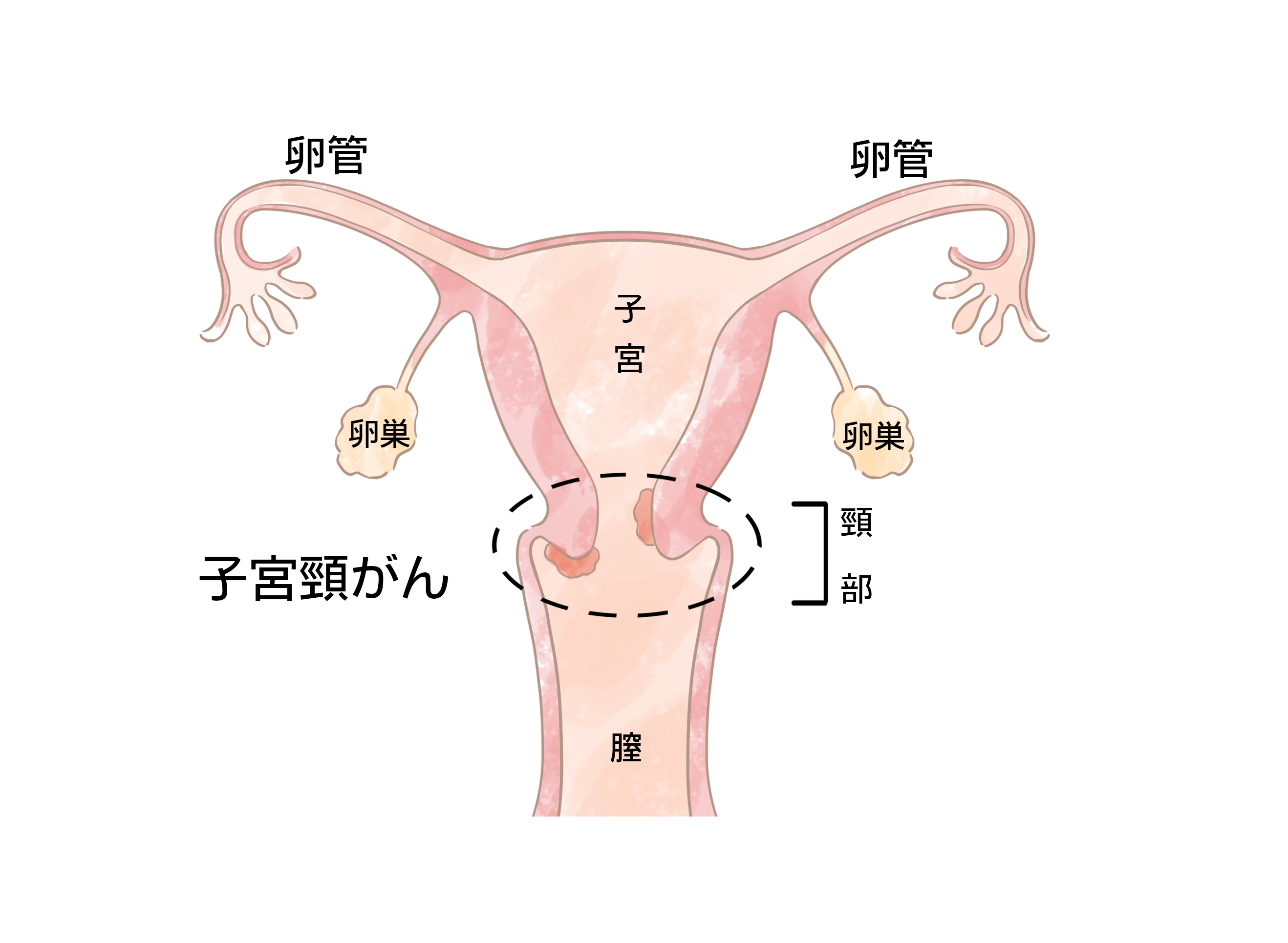 子宮 口 狭い と 言 われ た