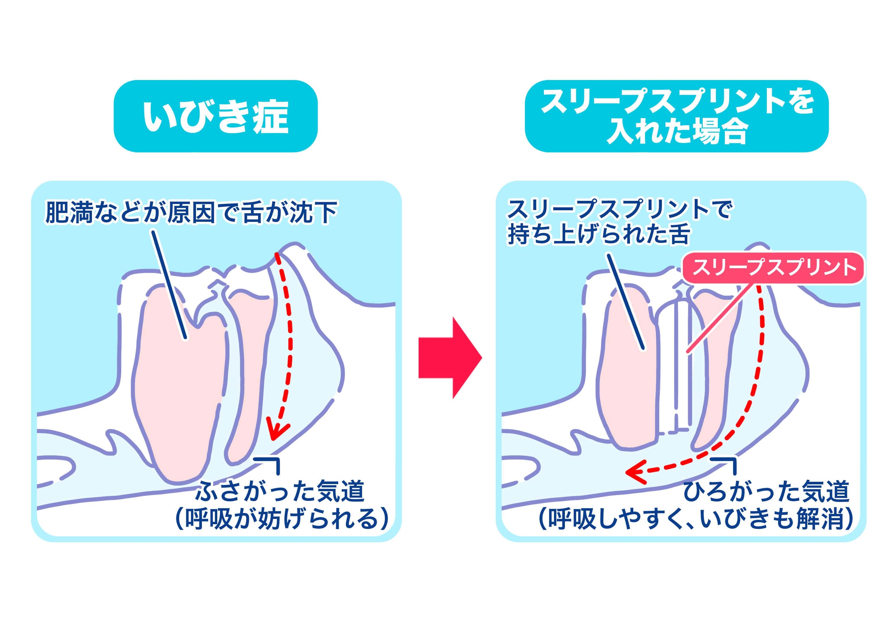 いびき_3-min.jpg