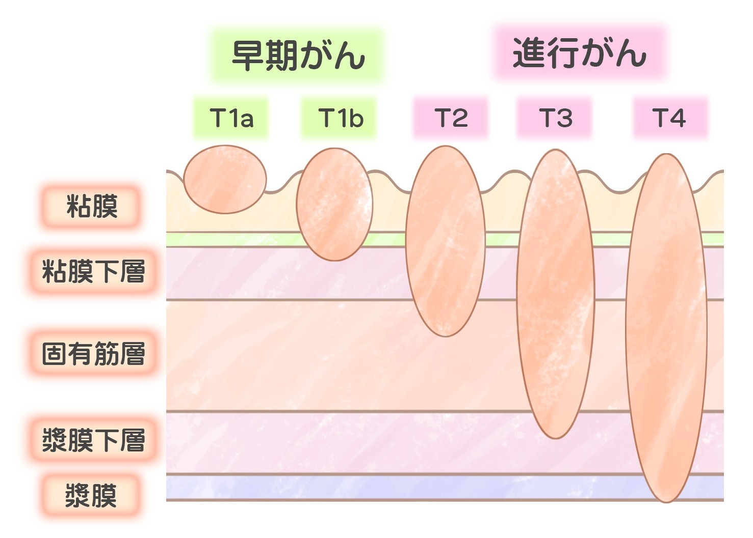 40代以降が意識したい胃がんとは リスク検査もチェック Ilacy アイラシイ 働く女性の医療メディア