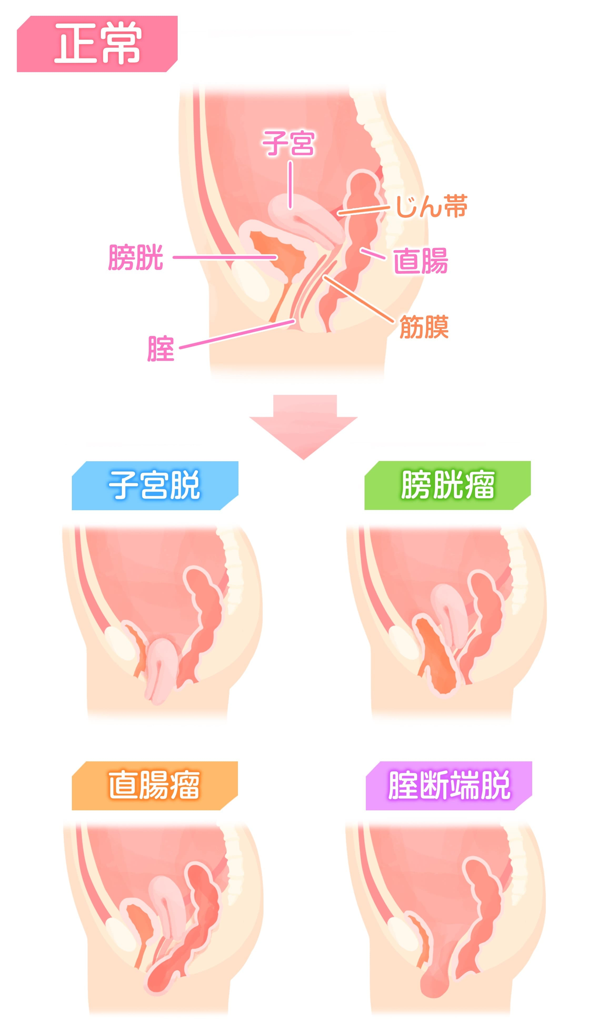 腟に何か挟まっている？尿が出にくい！デリケートゾーンの違和感の謎‐ILACY(アイラシイ)働く女性の医療メディア