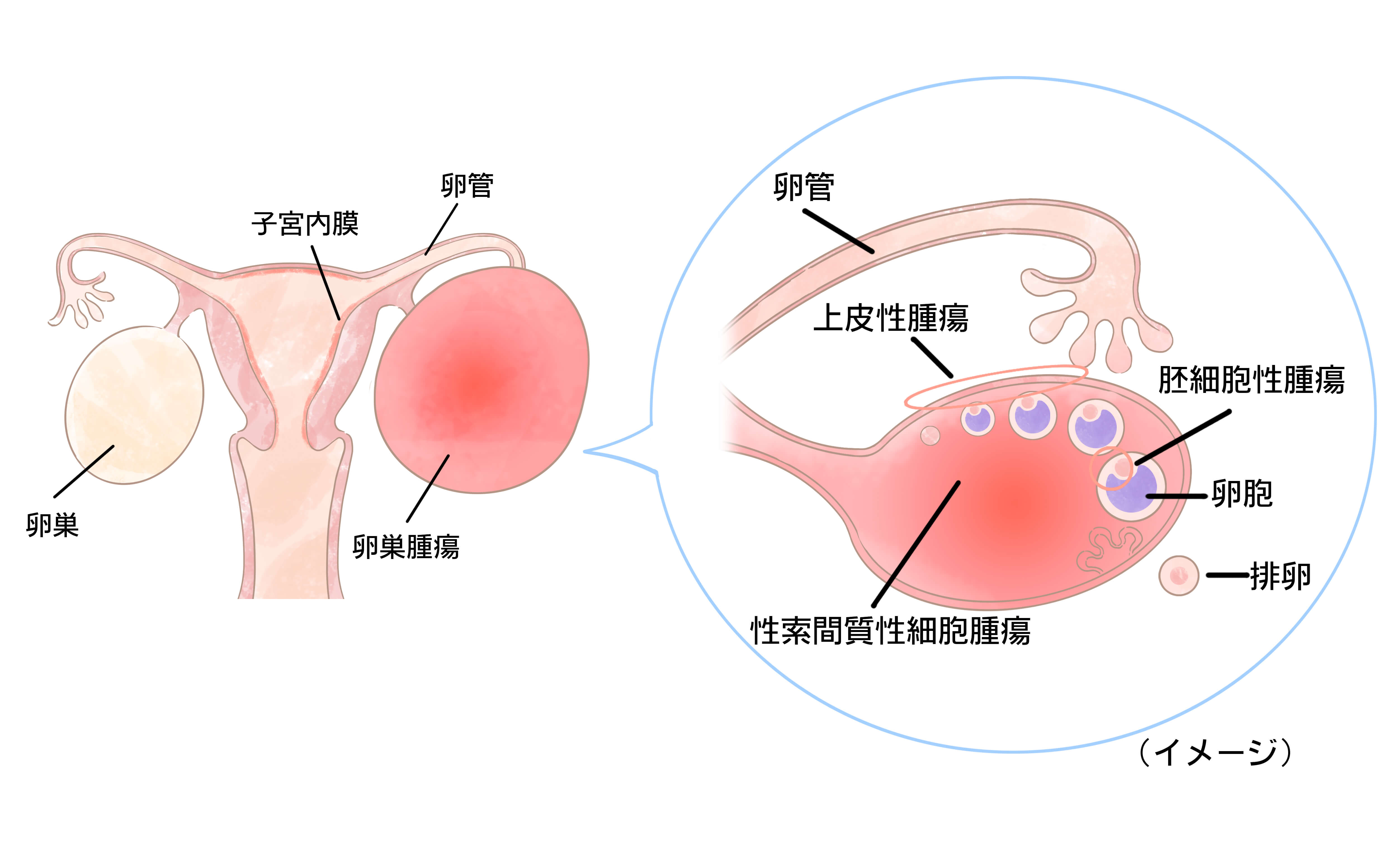 卵巣 癌 ブログ わたし は わたし