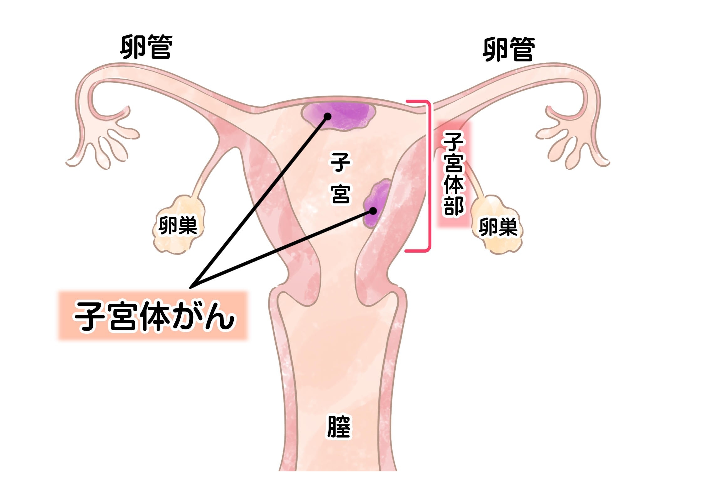 閉経前後の不正出血を見逃さないで！子宮体がんの特徴とは？‐ILACY(アイラシイ)働く女性の医療メディア