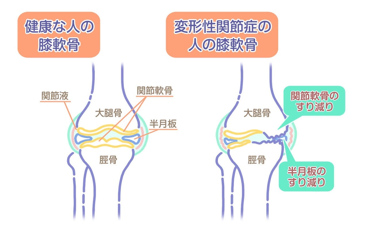 ひざ痛_3-min.jpg