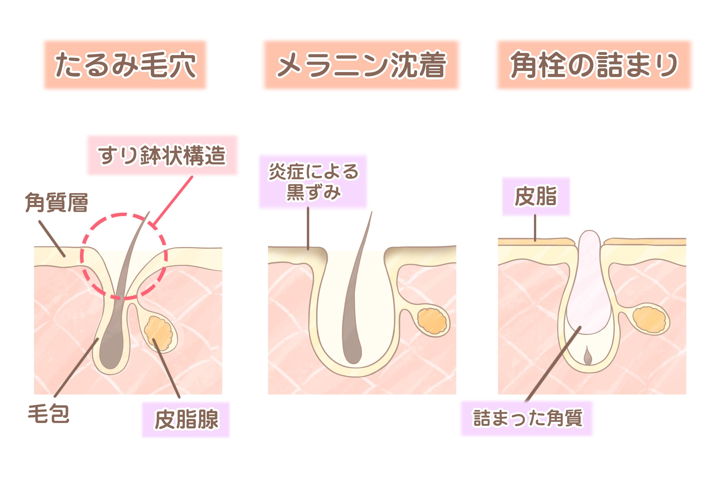 頭皮 の 毛穴 詰まり