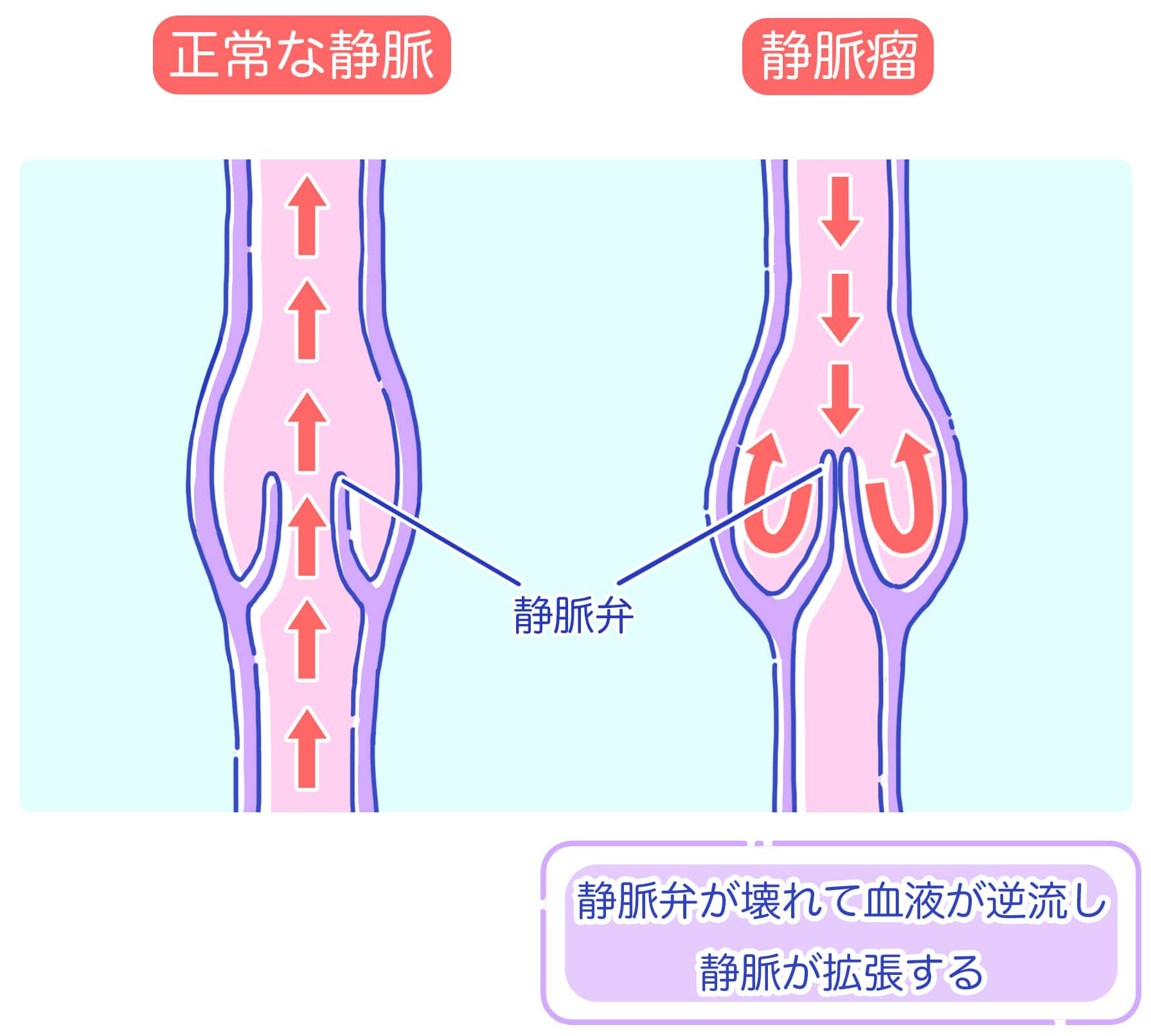 下肢静脈瘤_2-min (トリミング).jpg