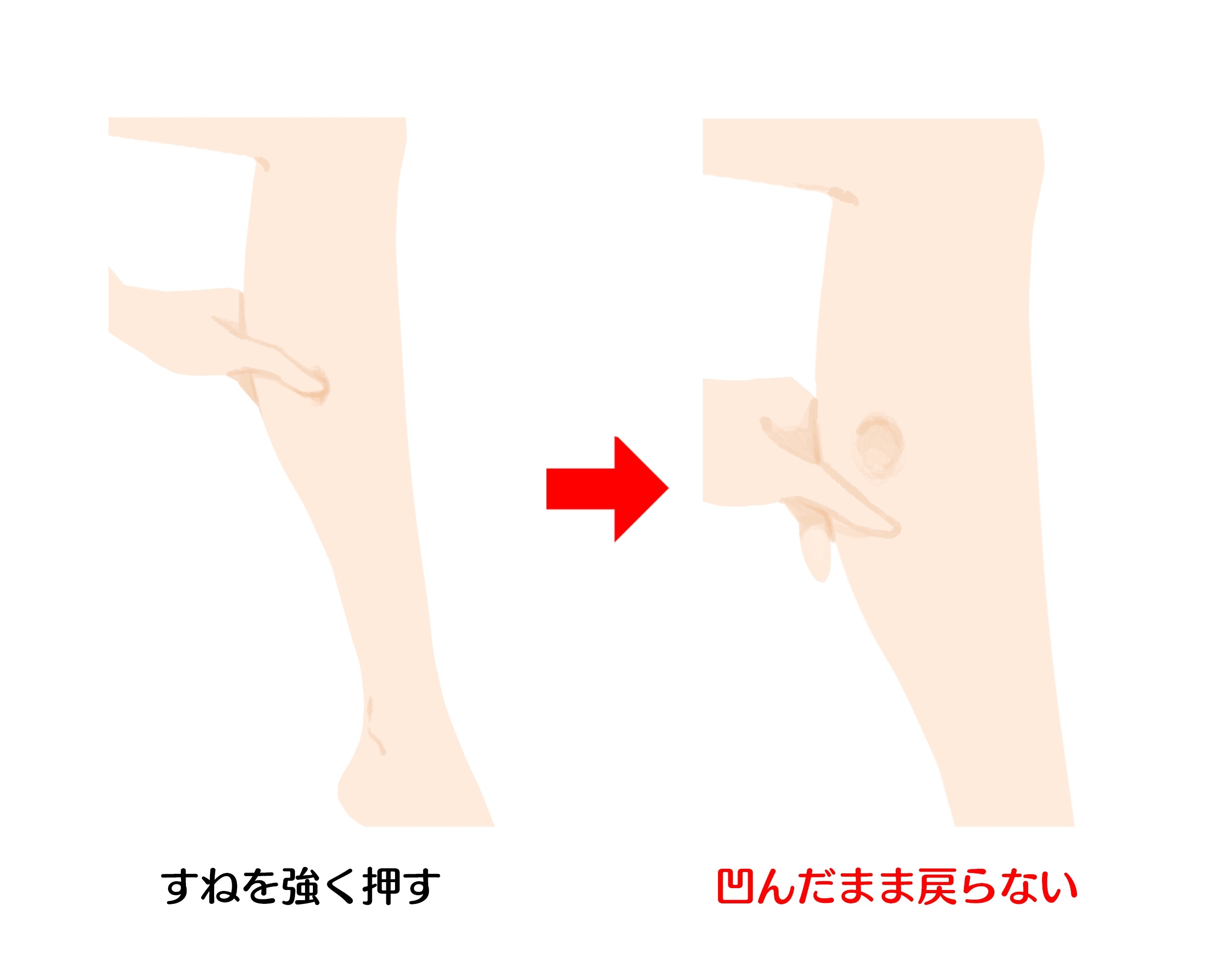 更年期のむくみを改善するには へこみが戻らないむくみには要注意 Ilacy アイラシイ 働く女性の医療メディア