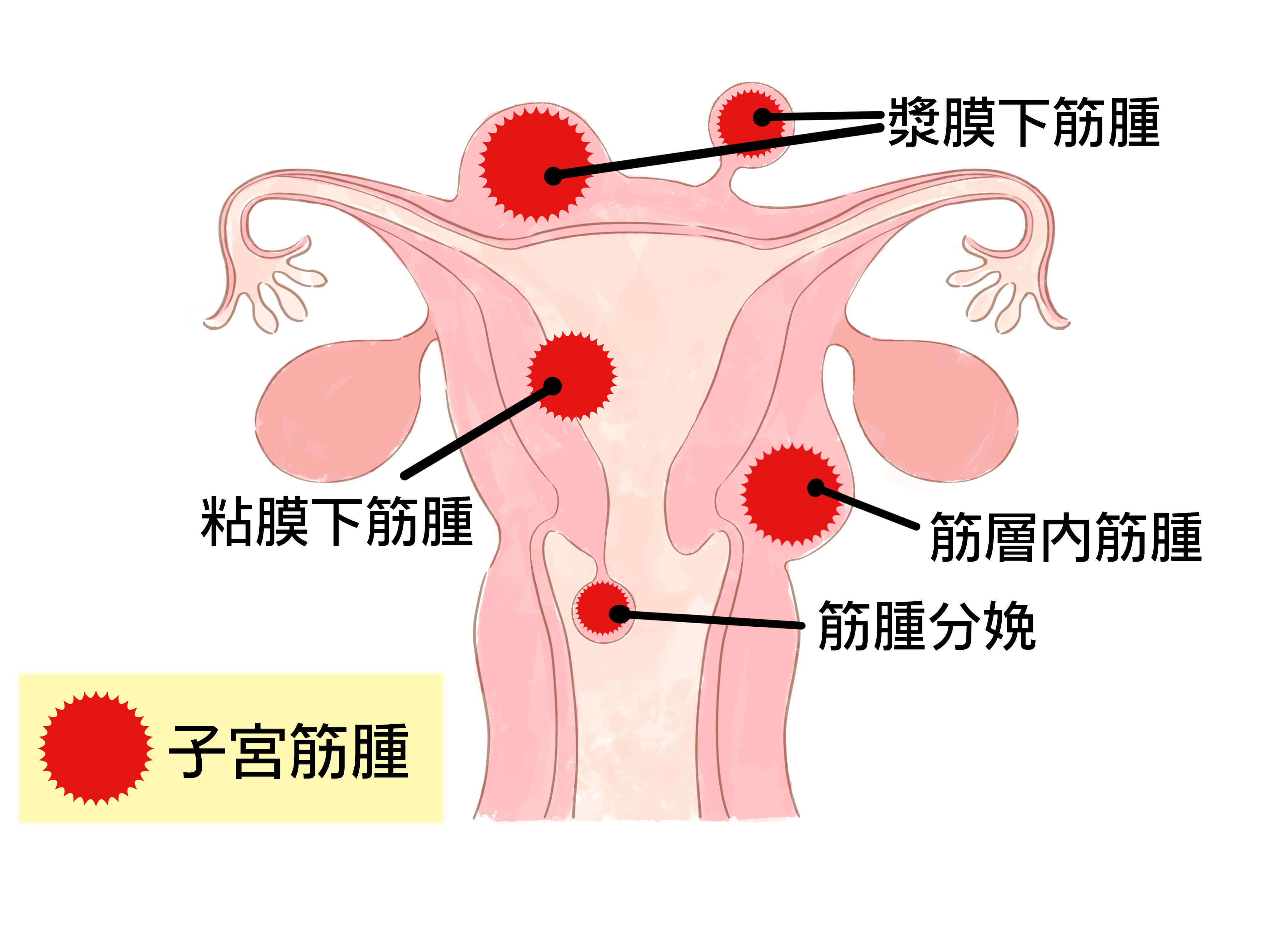 筋腫 子宮